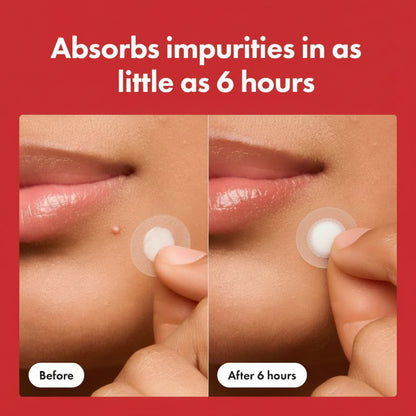 Hydrocolloid Pimple Patch – Invisible Acne Spot Treatment